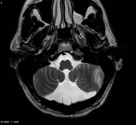 normal fetal cisterna magna mri