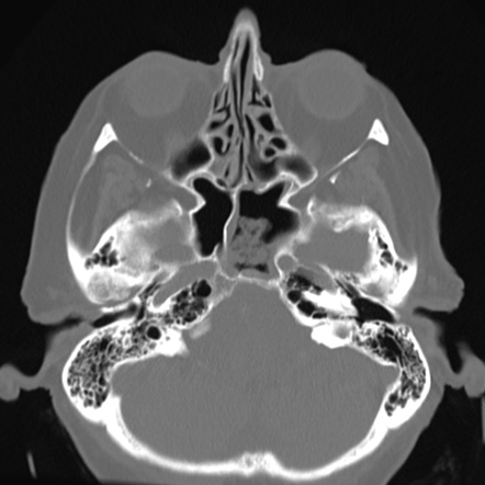 Koala in sphenoid sinus | Radiology Case | Radiopaedia.org