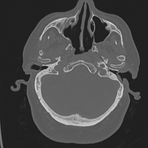 Anterior communicating artery aneurysm and left canal wall down ...