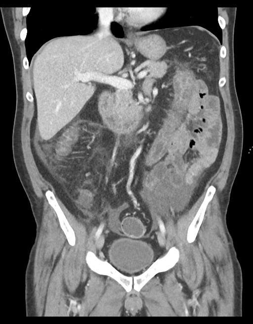 Typhlitis (neutropaenic colitis) | Image | Radiopaedia.org