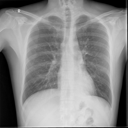 Lobar consolidation | Radiology Reference Article | Radiopaedia.org