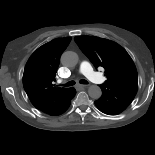 File:Tumor thrombus in right atrium, IVC and right renal vein. from ...