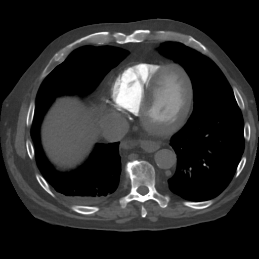 File:Tumor thrombus in right atrium, IVC and right renal vein. from ...