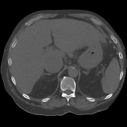 File:Tumor thrombus in right atrium, IVC and right renal vein. from ...