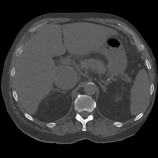 File:Tumor thrombus in right atrium, IVC and right renal vein. from ...