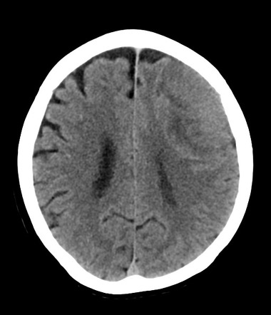 Atypical meningioma (WHO grade II) | Radiology Case | Radiopaedia.org