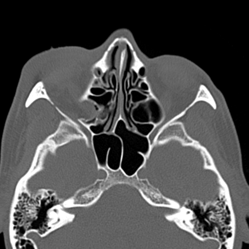 Orbital floor fracture with ruptured globe | Image | Radiopaedia.org