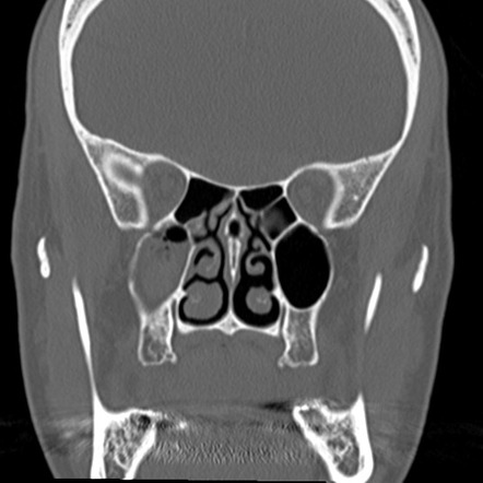 Orbital floor fracture with ruptured globe | Image | Radiopaedia.org