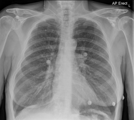 Calcified pulmonary nodules | Radiology Reference Article | Radiopaedia.org