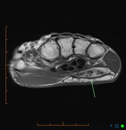 Fibrolipoma of the ulnar nerve | Radiology Case | Radiopaedia.org