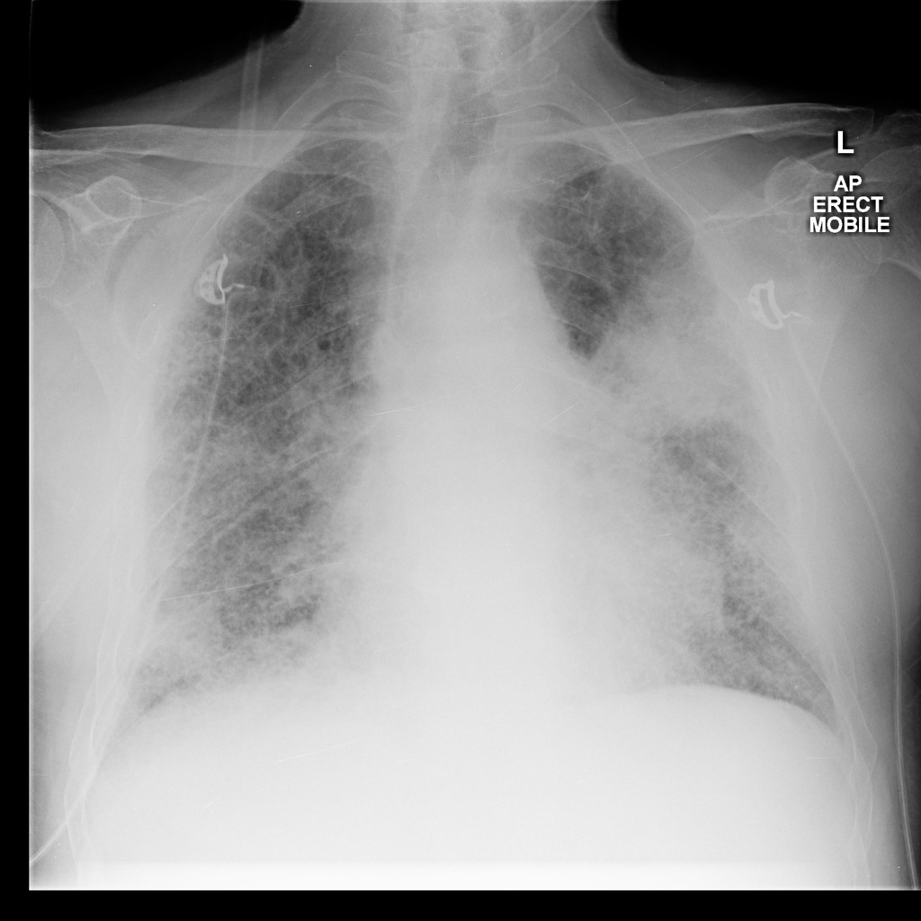 Pulmonary Fibrosis Infection And Primary Lung Cancer Radiology Case Radiopaedia Org