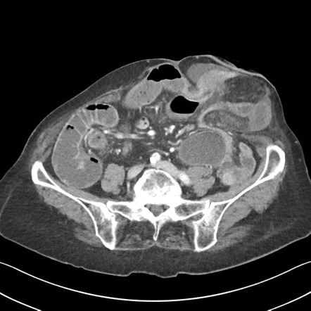 Closed loop obstruction Radiology Case Radiopaedia