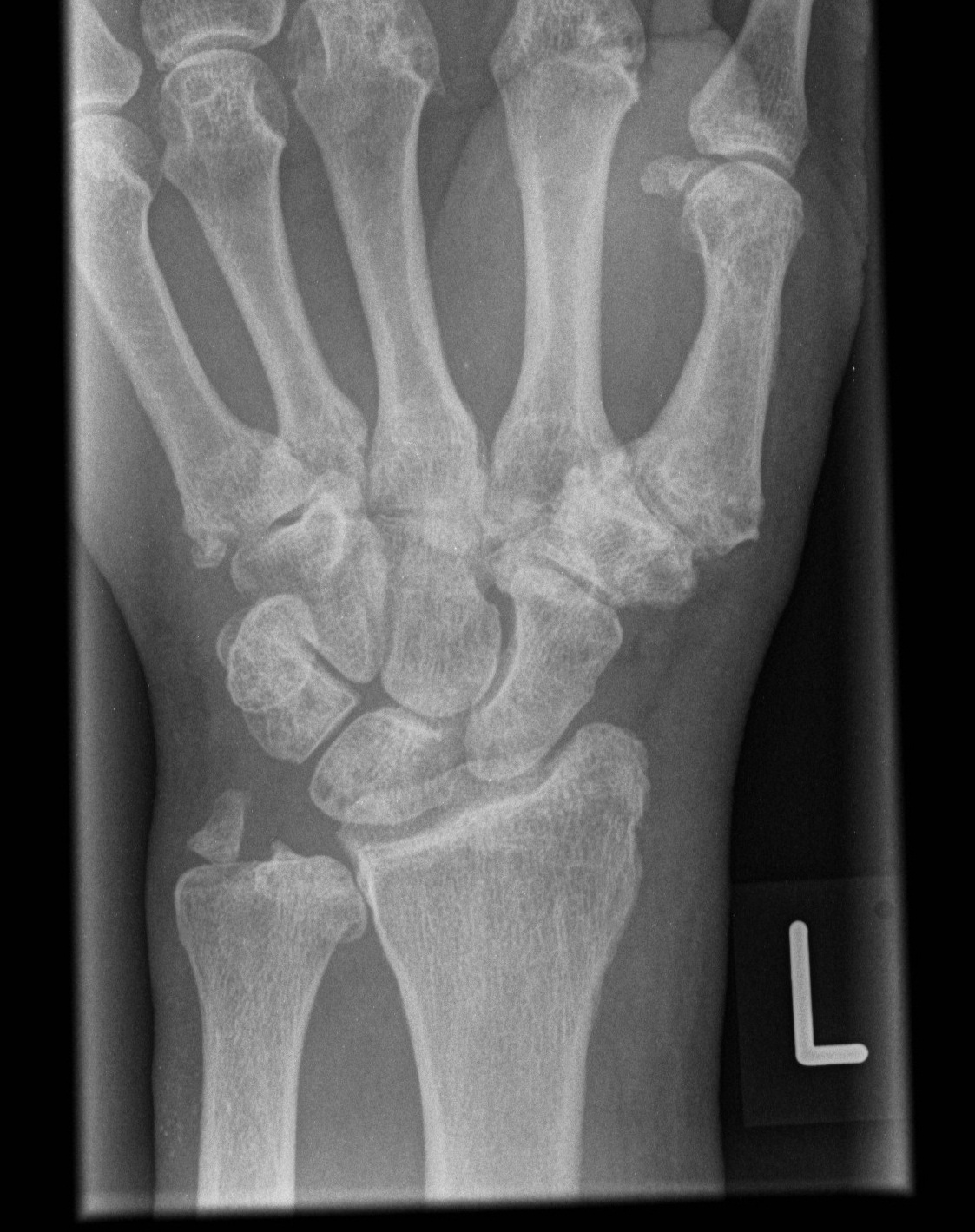 Triquetral And Wrist Fractures Image 4197