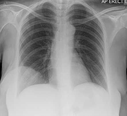 Breast neoplasms | Radiology Reference Article | Radiopaedia.org