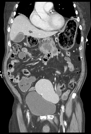 wandering spleen ultrasound