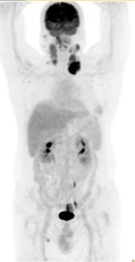 Elastofibroma Dorsi Pet Ct Image