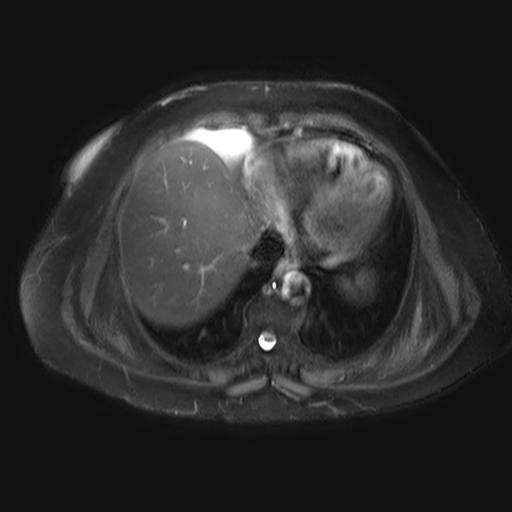 Elastofibroma Dorsi | Image | Radiopaedia.org