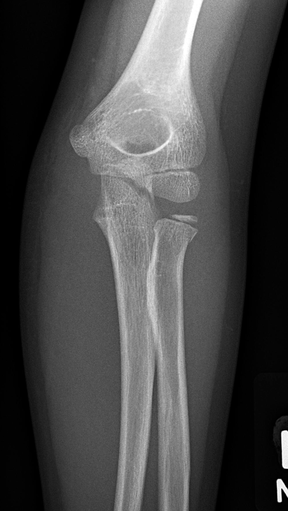 Olecranon and radial neck fractures | Image | Radiopaedia.org