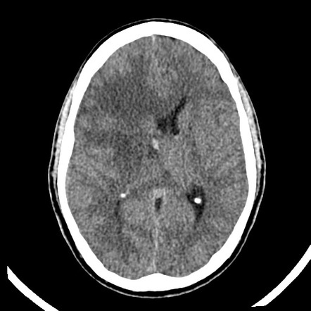 Glioblastoma NOS | Radiology Case | Radiopaedia.org