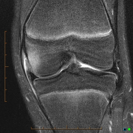 Medial Femoral Condyle Avulsion Fracture Image Radiopaediaorg Images