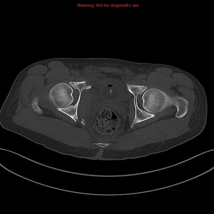 Malgaigne fracture | Image | Radiopaedia.org