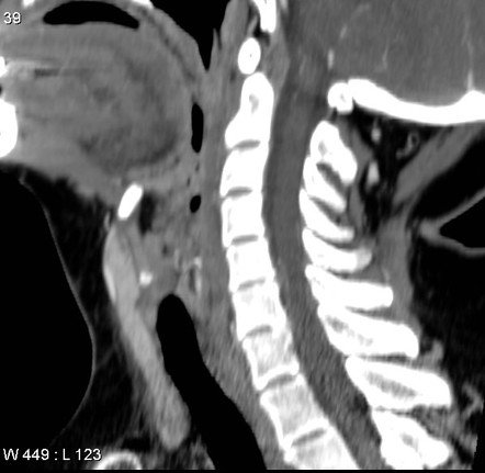 Pyramidal lobe of thyroid | Radiology Reference Article | Radiopaedia.org