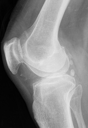 Chondrocalcinosis of the knee | Image | Radiopaedia.org