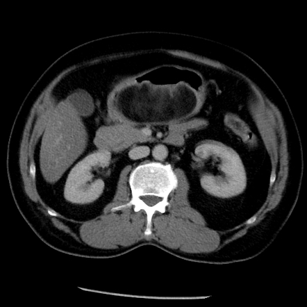 Gastric lipoma | Radiology Reference Article | Radiopaedia.org