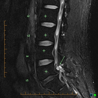 Synovial cyst arising from a lumbar pars defect | Image | Radiopaedia.org