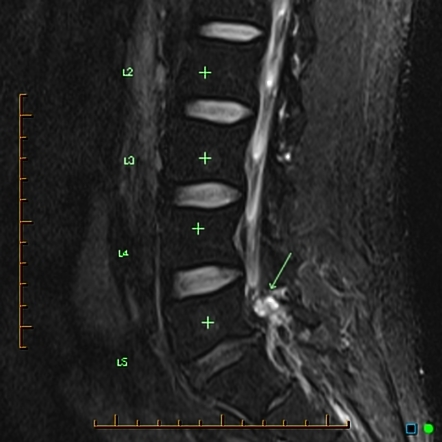 Synovial cyst arising from a lumbar pars defect | Image | Radiopaedia.org