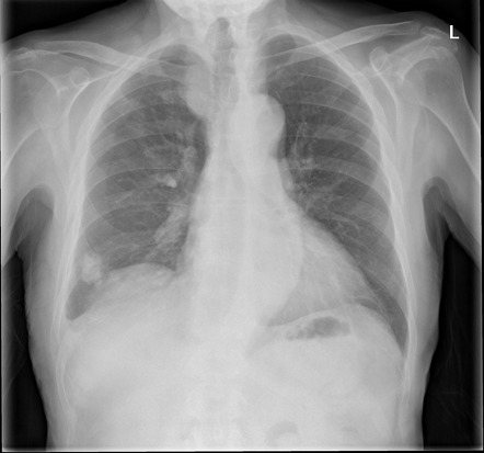 Pleural plaque | Radiology Reference Article | Radiopaedia.org