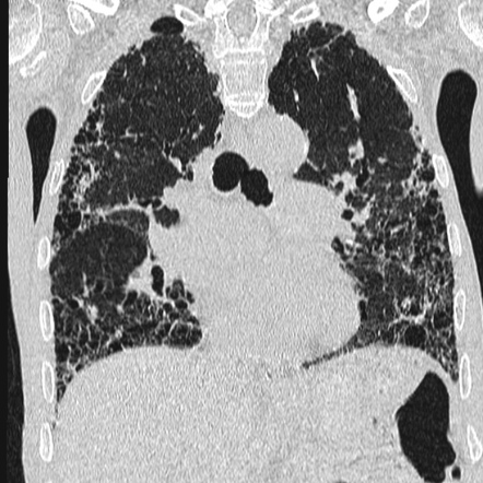 Diagnostic HRCT criteria for usual interstitial pneumonia (UIP) pattern ...