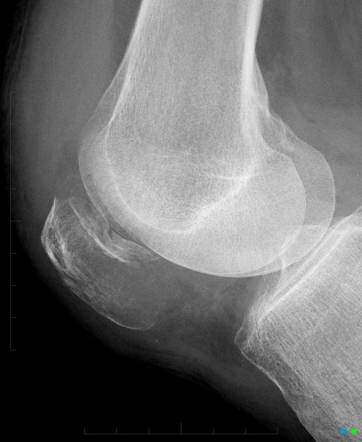 Metastasis to the patella: carcinoma of the lung | Radiology Case ...