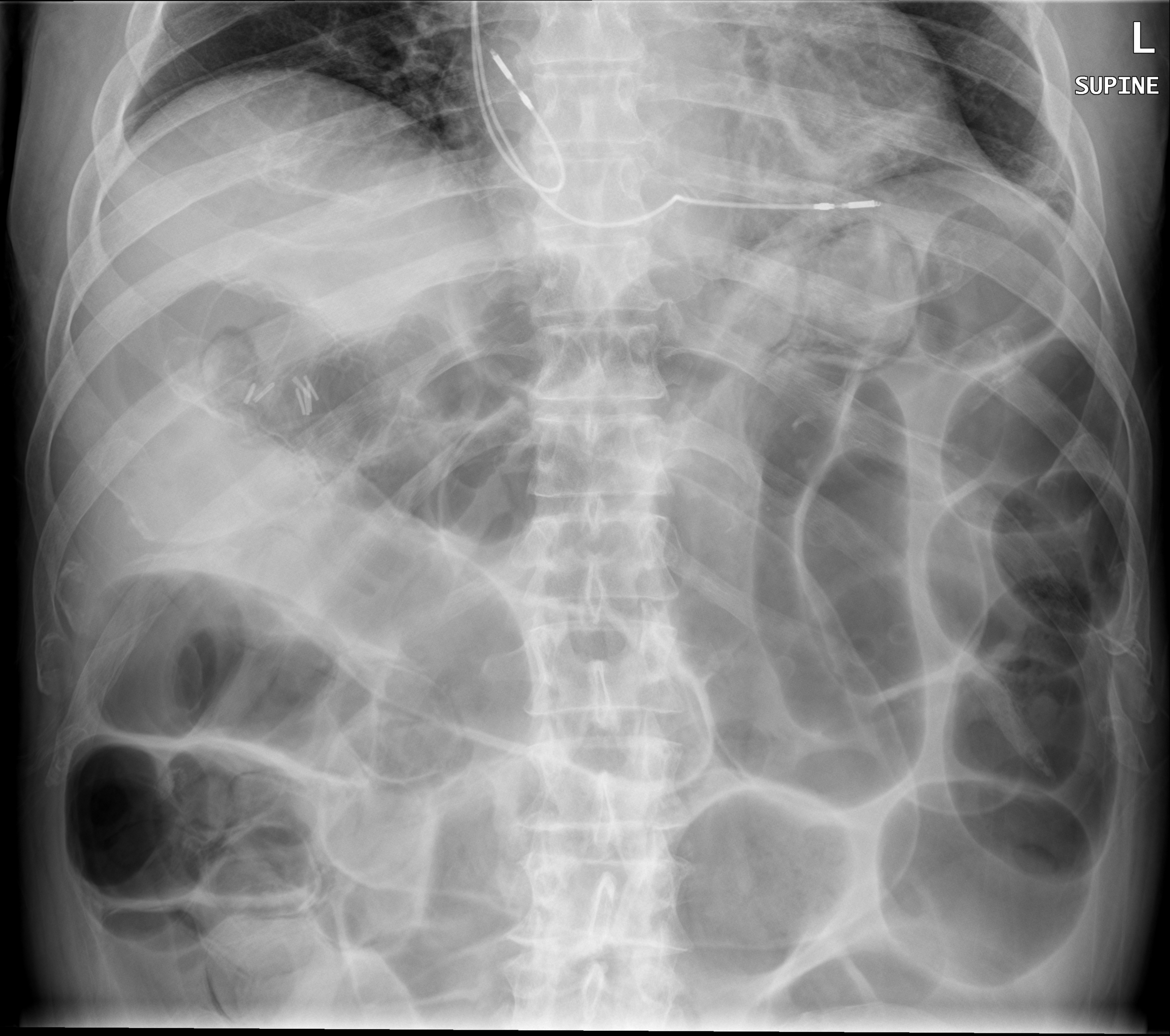 Rigler sign and pneumatosis intestinalis | Image | Radiopaedia.org