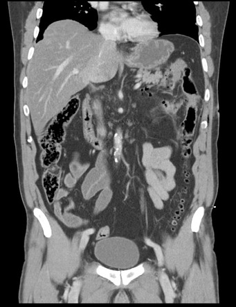 Penetrating renal trauma (urinoma) | Image | Radiopaedia.org