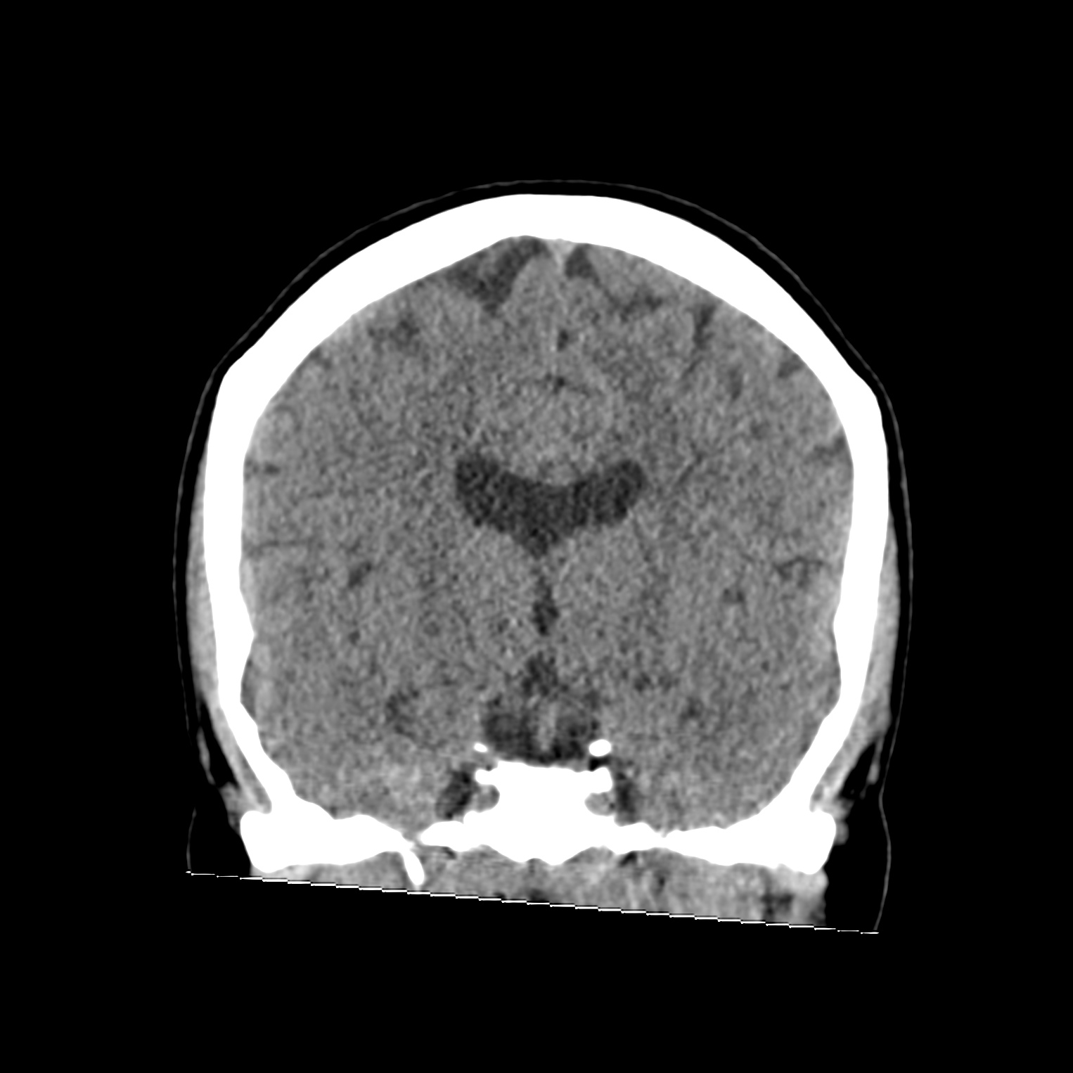 hypoxic-ischemic-brain-injury-image-radiopaedia