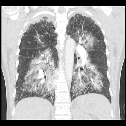 Pulmonary edema | Radiology Reference Article | Radiopaedia.org