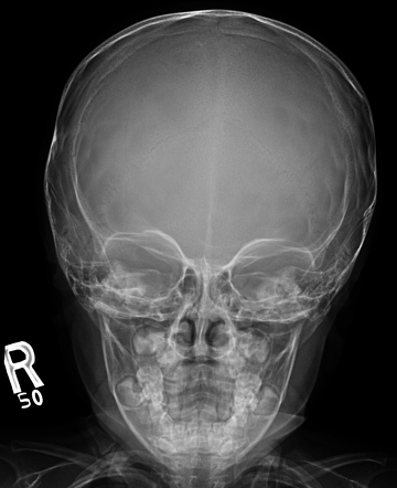 Metaphyseal chondrodysplasia | Radiology Case | Radiopaedia.org