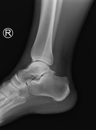 Osteochondral fracture of the talar dome | Image | Radiopaedia.org