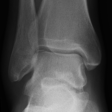 Osteochondral fracture | Radiology Reference Article | Radiopaedia.org