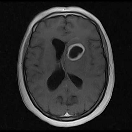 Tuberculous abscess | Radiology Reference Article | Radiopaedia.org