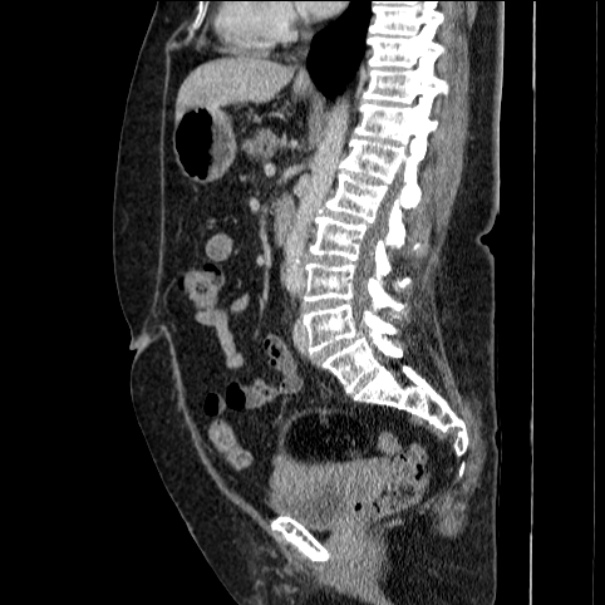 Mature ovarian teratoma | Image | Radiopaedia.org