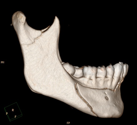 Bilateral Mandibular Fracture