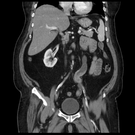 Transitional cell carcinoma (ureter) | Radiology Reference Article ...