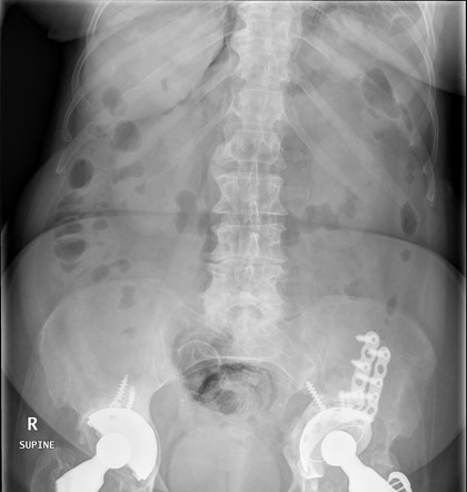 Pneumoretroperitoneum | Radiology Case | Radiopaedia.org