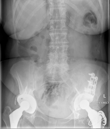 Pneumoretroperitoneum | Image | Radiopaedia.org