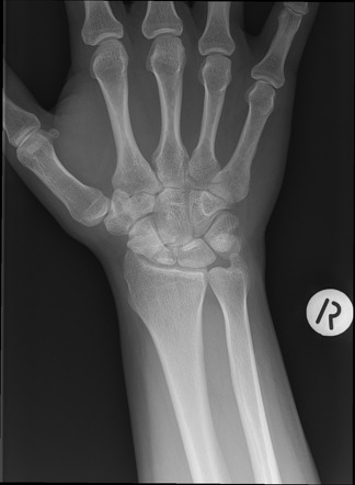 Scaphoid-FOOSH – OrthoPaedia