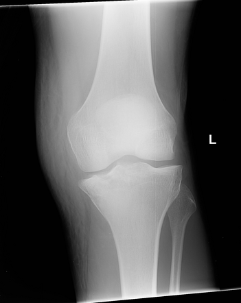 Medial tibial plateau fracture | Radiology Case | Radiopaedia.org