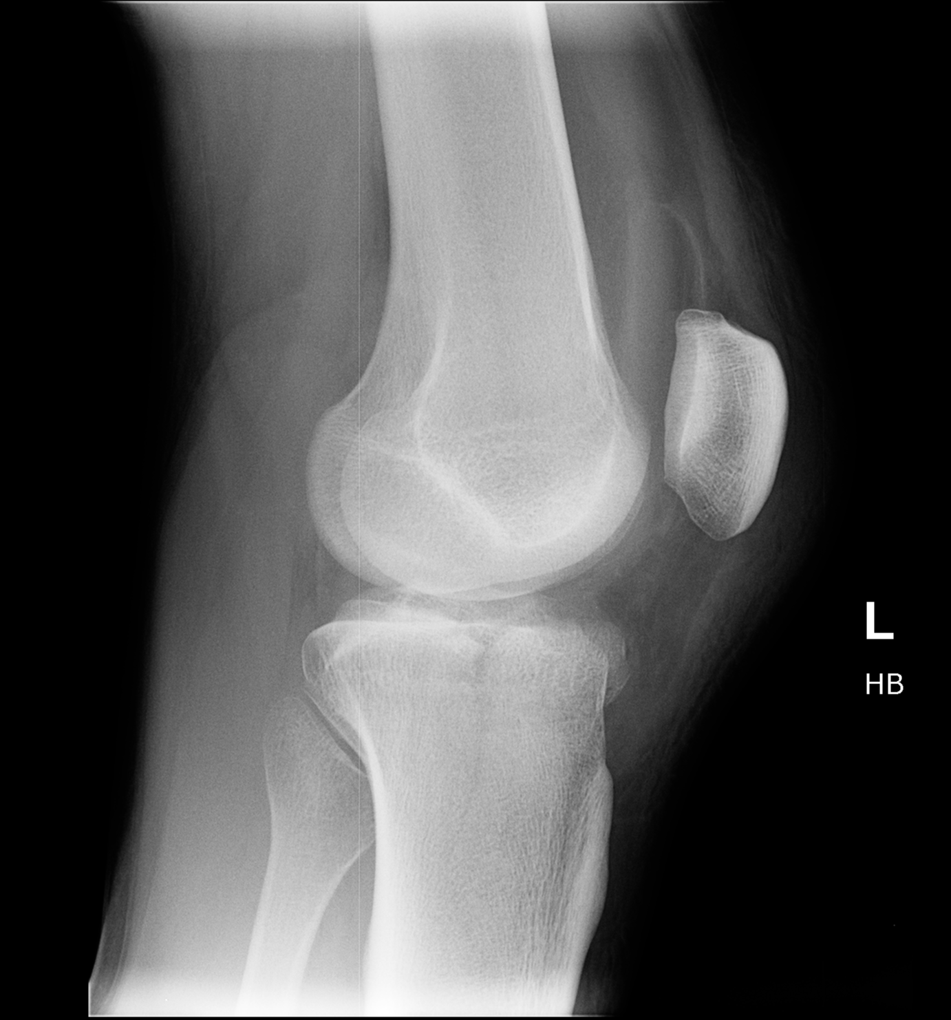 Medial Tibial Plateau Fracture | Image | Radiopaedia.org