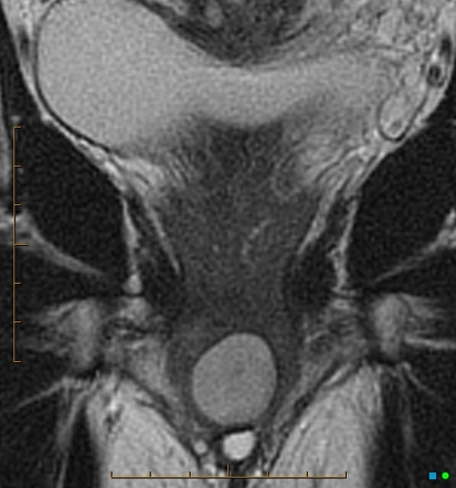 Skene gland cyst | Image | Radiopaedia.org